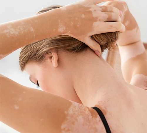 הויטיליגו שלי – מי ידע שזו הסיבה שהגעת לחיי?